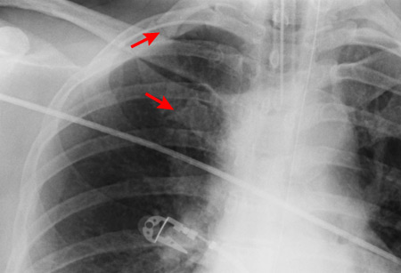 CXR showing right first rib fracture