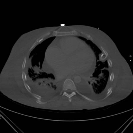CT scan showing bilateral posterior rib fractures