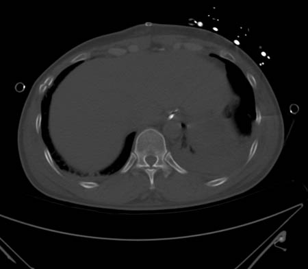 CT showing right anterolateral rib fracture