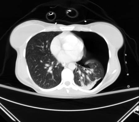 CT scan showing large left-sided pneumothorax