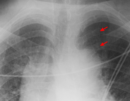 CXR showing multiple posterior left-sided rib fractures