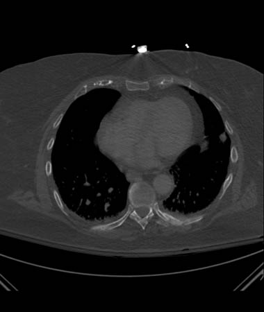 CT showing left posterior segmental rib fracture