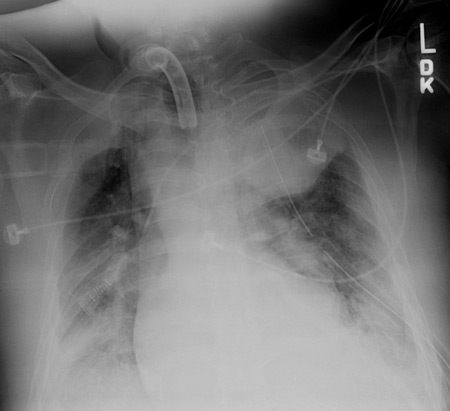 Anteroposterior CXR multiple left-sided rib fractures with chest tube in place