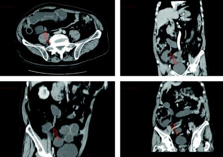 Abdominal CT scan showing small bowel obstruction with multiple air-fluid levels, dilated bowel loops and a transition zone in the right iliac fossa. Red arrows indicate the evident transition zone