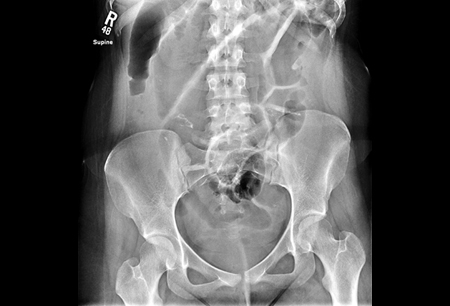 Small bowel obstruction images