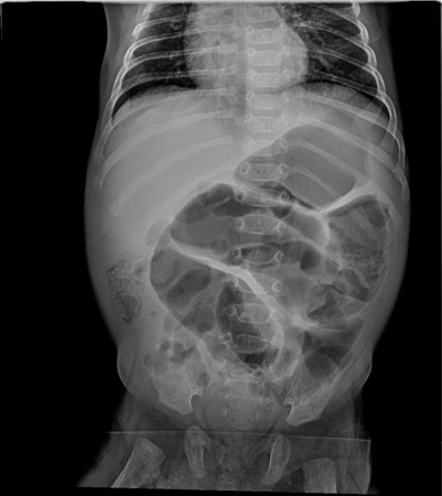 Abdominal x-ray showing complete intestinal obstruction