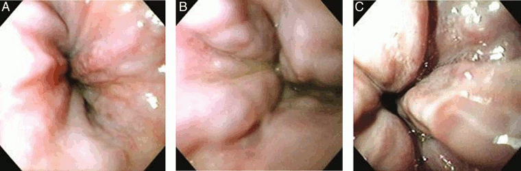 (A) Grade I esophageal varices. These collapse to inflation of the esophagus with air. (B) Grade II esophageal varices. These are varices between grades 1 and 3. (C) Grade III esophageal varices. These are large enough to occlude the lumen