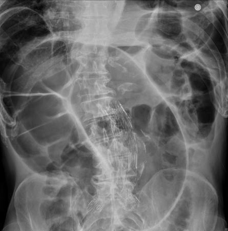 Abdominal radiograph showing dilated large bowel loops. Typical "coffee bean" sign seen for sigmoid volvulus