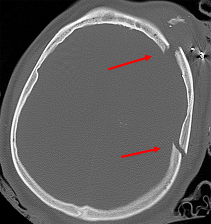 Gunshot wound with perpendicular blowout fracture