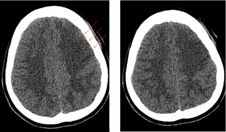 Left frontal infarct (arrows) in a patient with subarachnoid hemorrhage-related vasospasm
