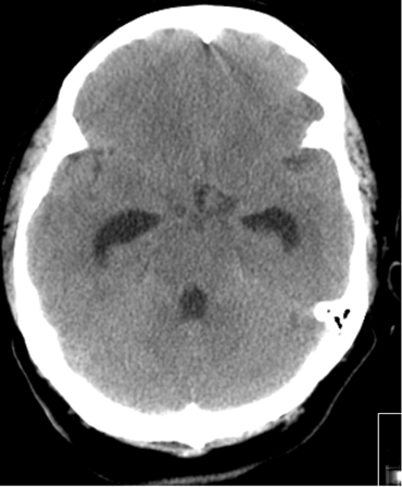 Communicating hydrocephalus in the setting of subarachnoid hemorrhage; note dilation of fourth and temporal horns of lateral ventricles