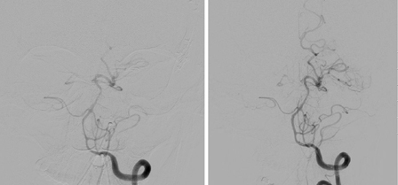 Distal left vertebral and basilar arteries spasm before (left) and after (right) intra-arterial infusion of nicardipine