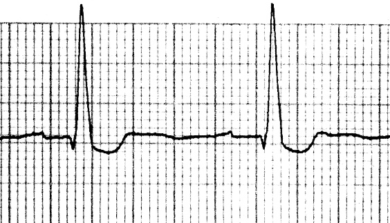 ECG showing digoxin effect