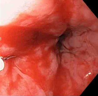 Epinephrine (adrenaline) is injected locally around the site of the Mallory-Weiss tear