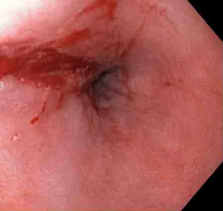 Mallory-Weiss tear after epinephrine injection (the bleeding has stopped, allowing better visualization of the lesion)
