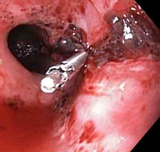 A through-the-scope clip deployed in the center of the lesion (no previous epinephrine was infused in this case)