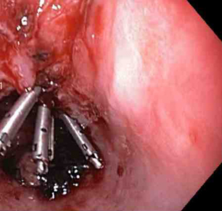 Three through-the-scope clips deployed to complete closure of the mucosal defect