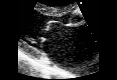 Estenose mitral images