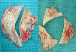 Aortic stenosis images