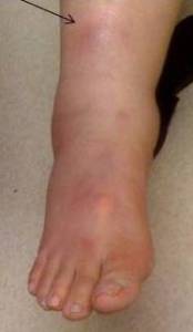 Erythema nodosum images