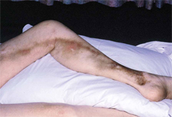 Superficial vein thrombosis images