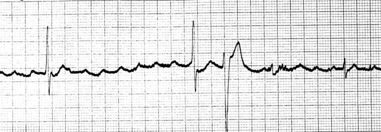 Digoxin overdose images