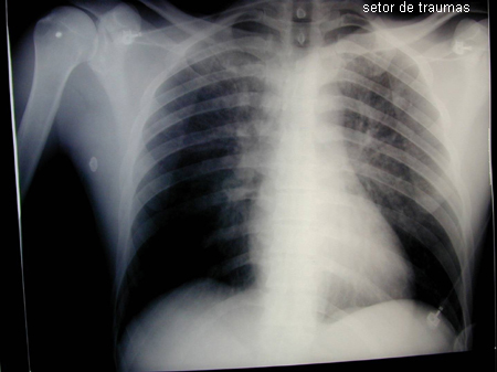 Superdosagem de opioides images
