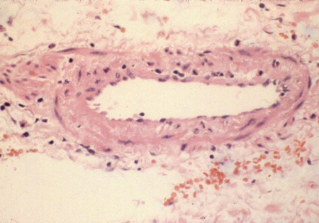 Poliarterite nodosa images