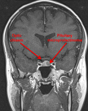 Prolactinoma images