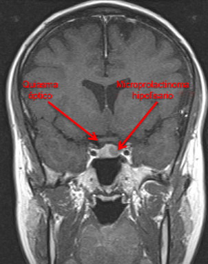 Prolactinoma images