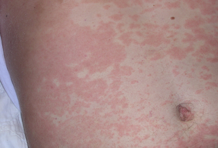 Common cutaneous drug reactions images
