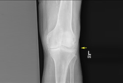 Calcium pyrophosphate deposition images