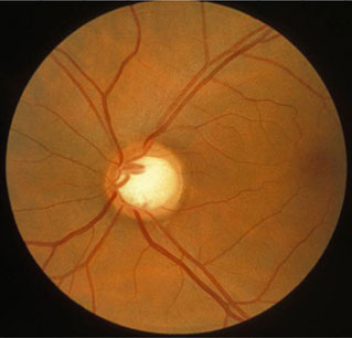 Open-angle glaucoma images