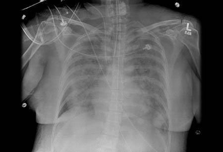 Acute respiratory distress syndrome (ARDS) images