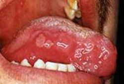 Behcet's syndrome images