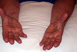 Carpal tunnel syndrome images
