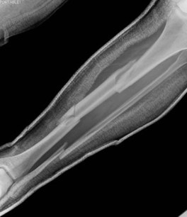 Long bone fracture images
