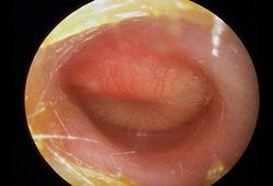 Acute otitis media images