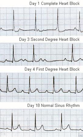 Rheumatic fever images