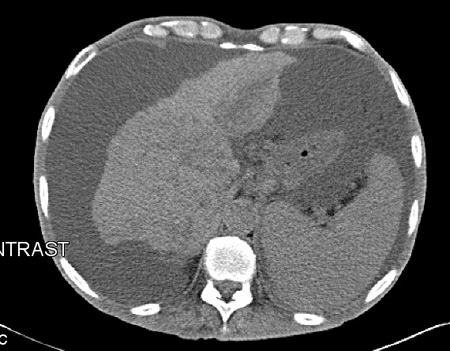 Avaliação da ascite images