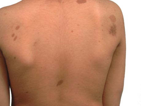 Type 1 neurofibromatosis images