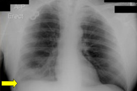 Infecção por Legionella images