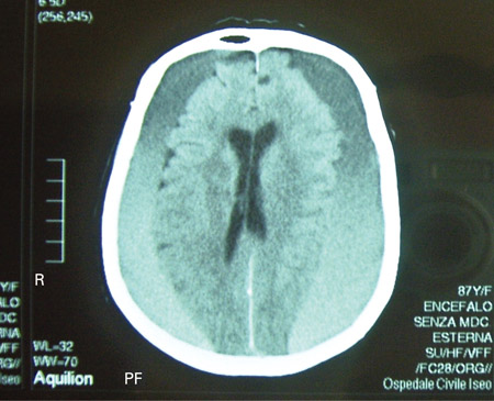 Subdural haematoma images