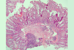 Crohn's disease images