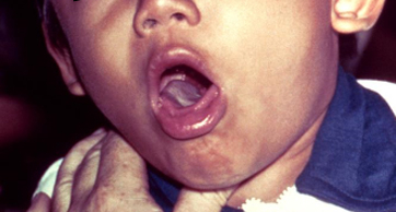 Laryngitis images