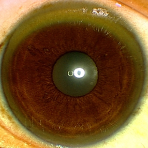 Wilson's disease images