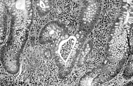 Colite ulcerativa images