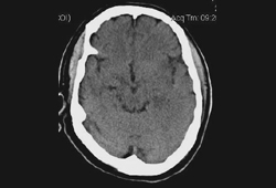 Encephalitis images