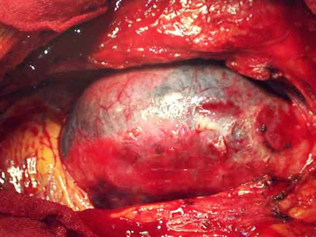 Dissecção da aorta images