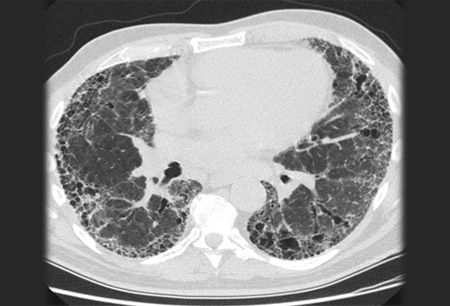 Idiopathic pulmonary fibrosis images